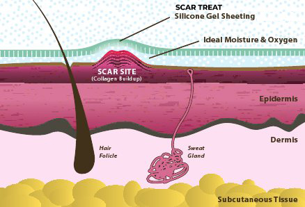 Scar Treat – Get rid of Scars