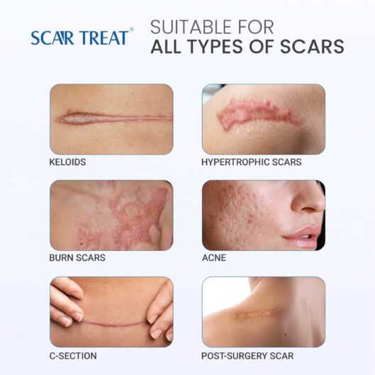 Scar Treat – Get rid of Scars