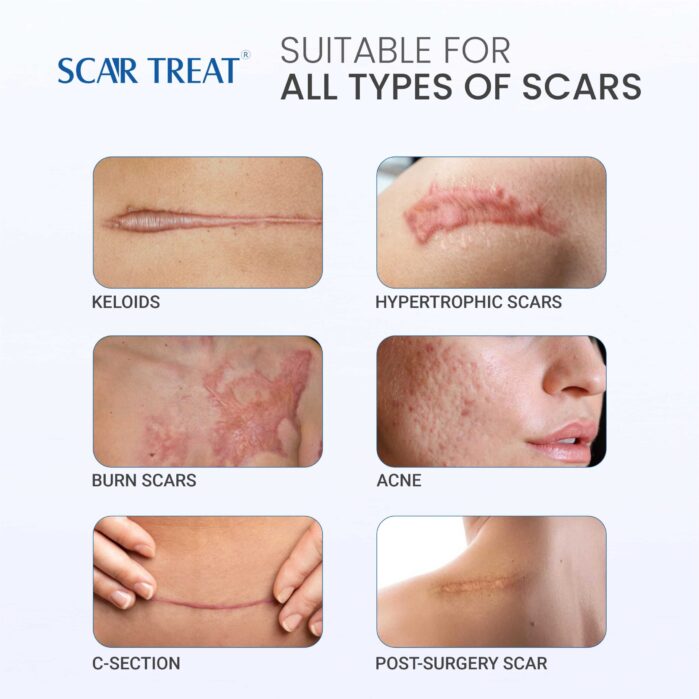 Scar Treat – Get rid of Scars