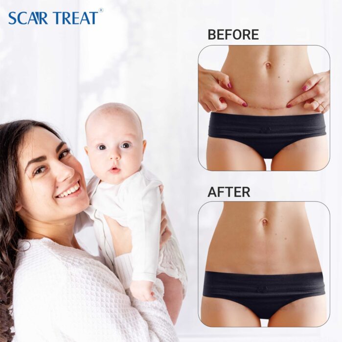Scar Treat – Get rid of Scars