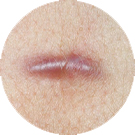 Keloid Scar