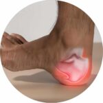 Night Derotation Brace