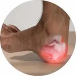 Night Derotation Brace