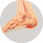 night derotation brace